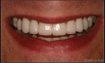 A Smile Makeover by Dr. Charles Payet – 8 Porcelain Veneers