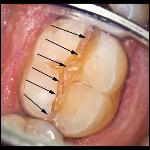 teeth-with-cracks-2