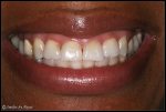 Smile Makeover to Correct a Gummy Smile – BEFORE photo