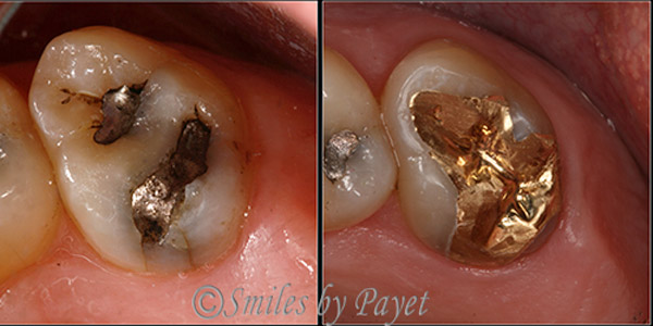 Family dentist Dr. Charles Payet used a gold onlay to fix a cracked tooth that had an old silver filling.